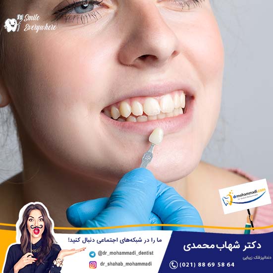 استحکام کامپوزیت دندان - کلینیک دندانپزشکی دکتر شهاب محمدی
